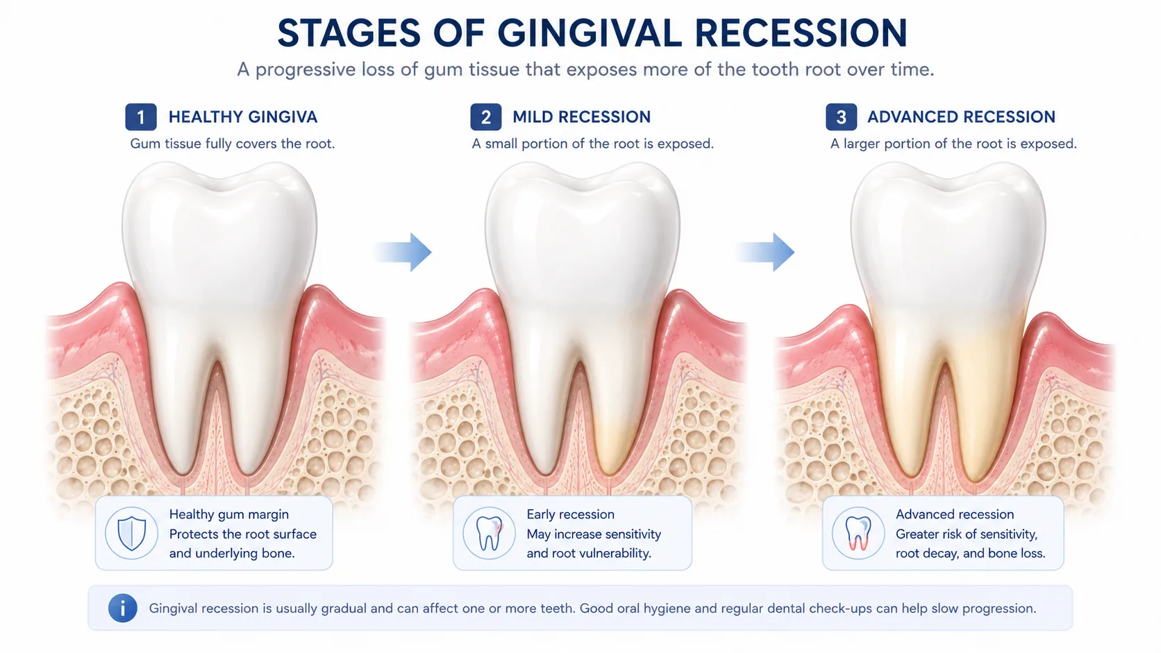 Comparison diagram of a tooth with a healthy 1-3mm gingival sulcus next to a tooth with a deep periodontal pocket filled with bacteria and plaque