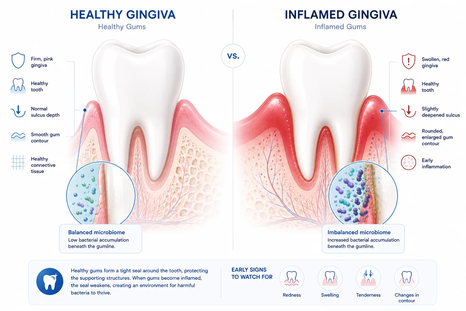 Cross-section diagram of the gingival sulcus showing anaerobic gram-negative bacteria accumulating in a low-oxygen environment with dilated blood vessels in surrounding gum tissue