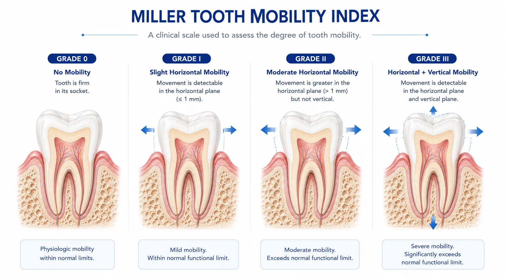 Diagram of a tooth showing the horizontal and vertical movement directions assessed by the Miller Mobility Index, labeled with Grade 0 through Grade III